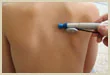 Patient receiving treatment on the back with a handheld pen-style device
